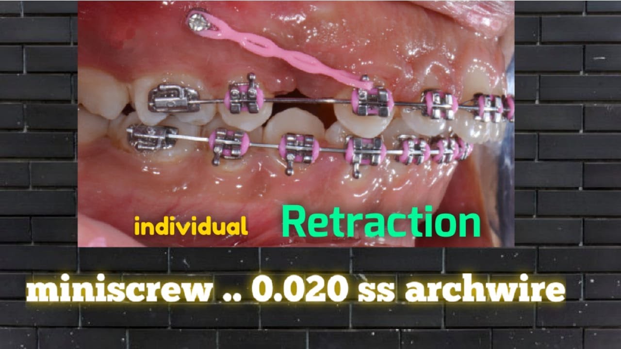 Case Report  Class 2 subdivision - Braces - Microdontia - Spaces - Composite buildup