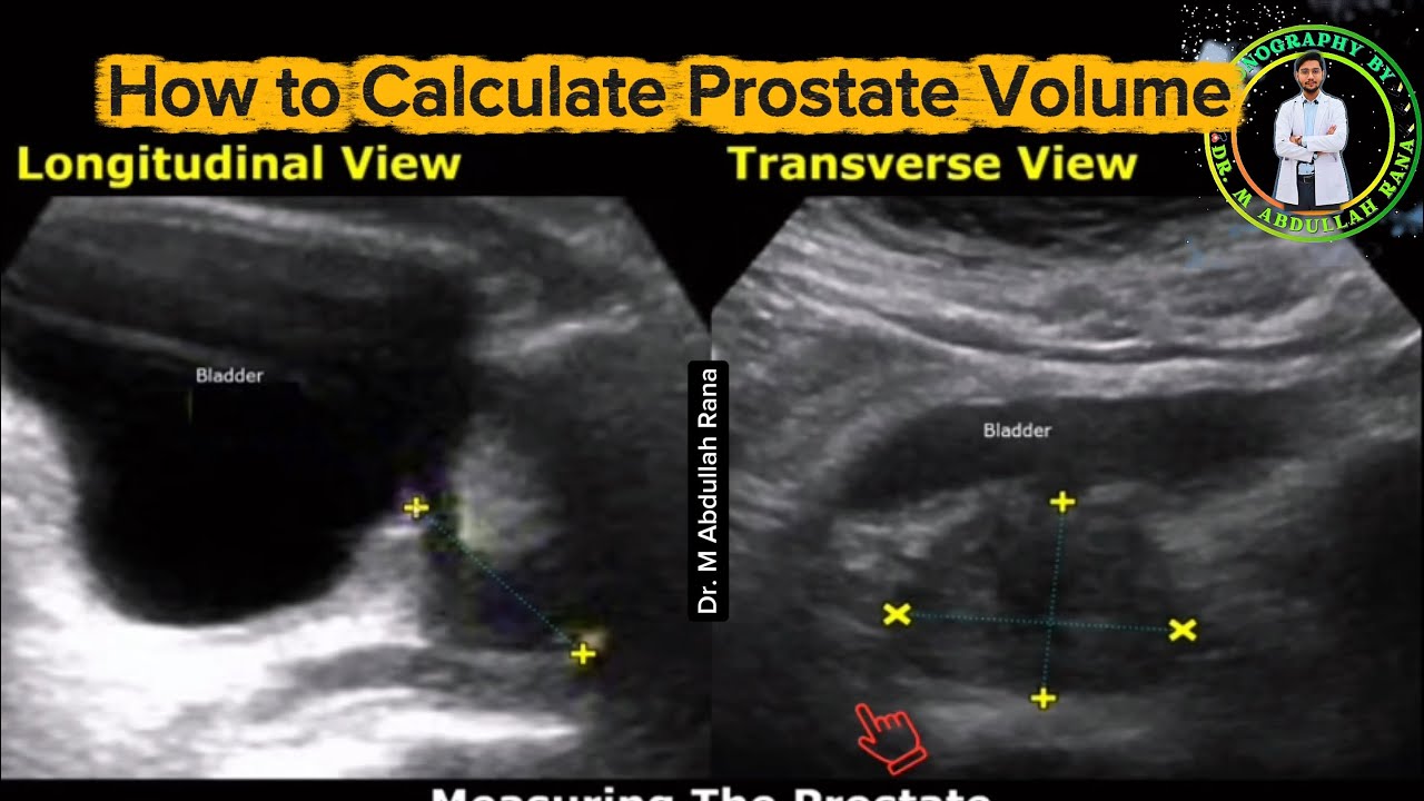 How to Calculate Prostate Volume || Ultrasound of Prostate || Normal Prostate Volume || By AR