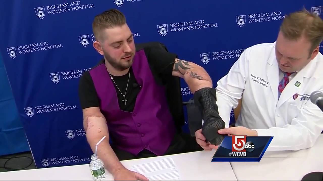 Marine who lost his limbs in Afghanistan recipient of arm transplant
