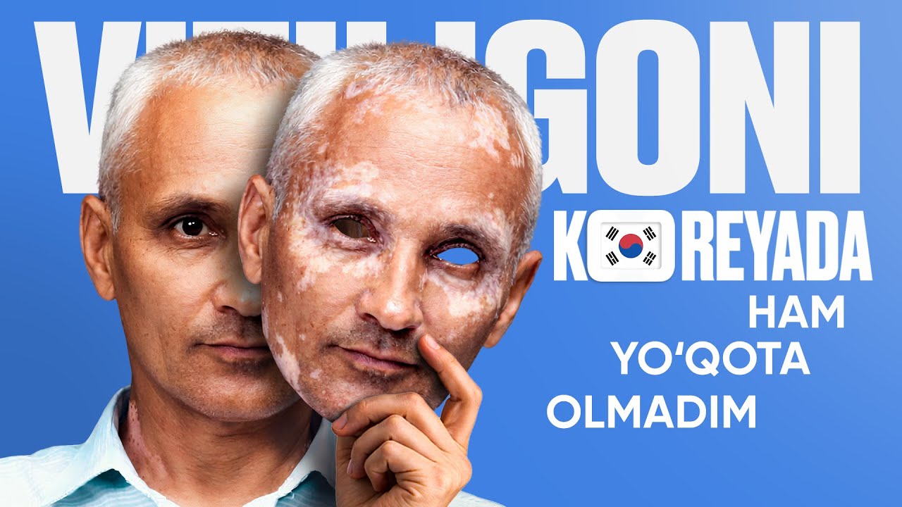 Oq dog'lardan 90 kundan qutulish &mdash; bemor hikoyasi | VITILIGO