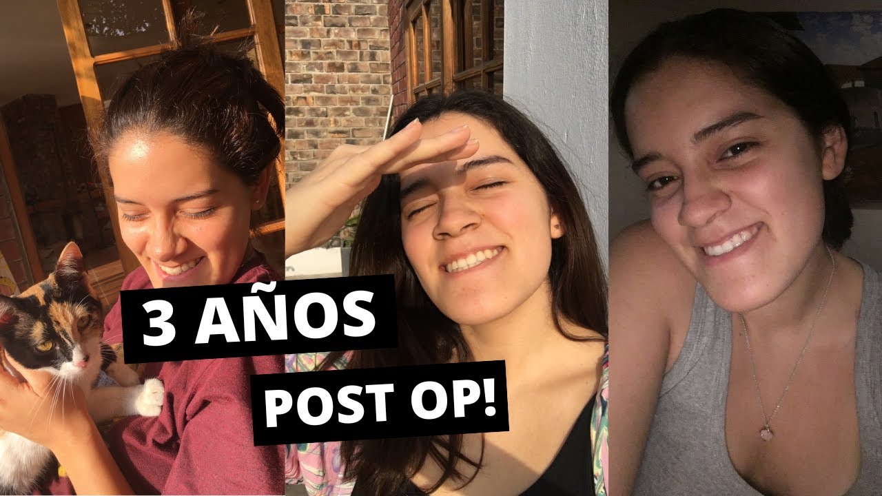 CIRUGIA ORTOGNATICA/ MAXILOFACIAL: 3 AÑOS POST OP.
