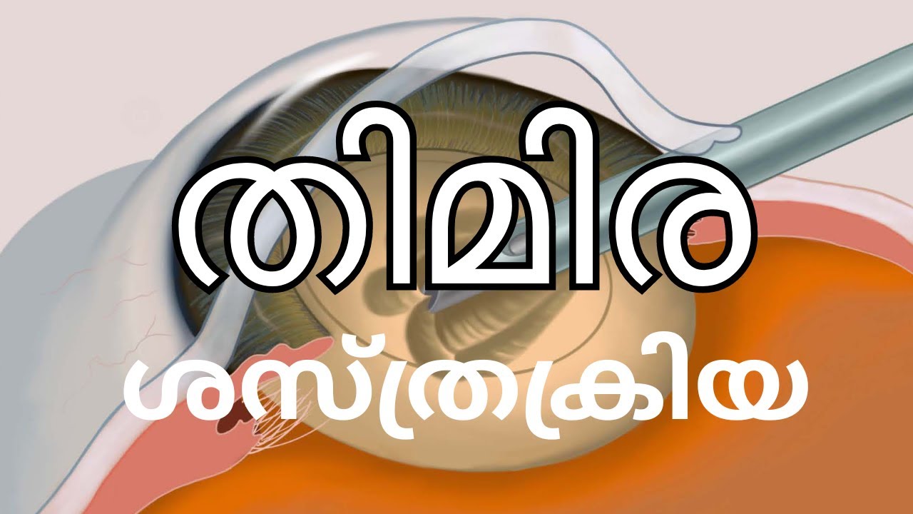 തിമിര ശസ്ത്രക്രിയ സൂക്ഷിക്കേണ്ട 10 കാര്യങ്ങൾ #cataractsurgery  # Arogyavicharam # Tv Live Asia