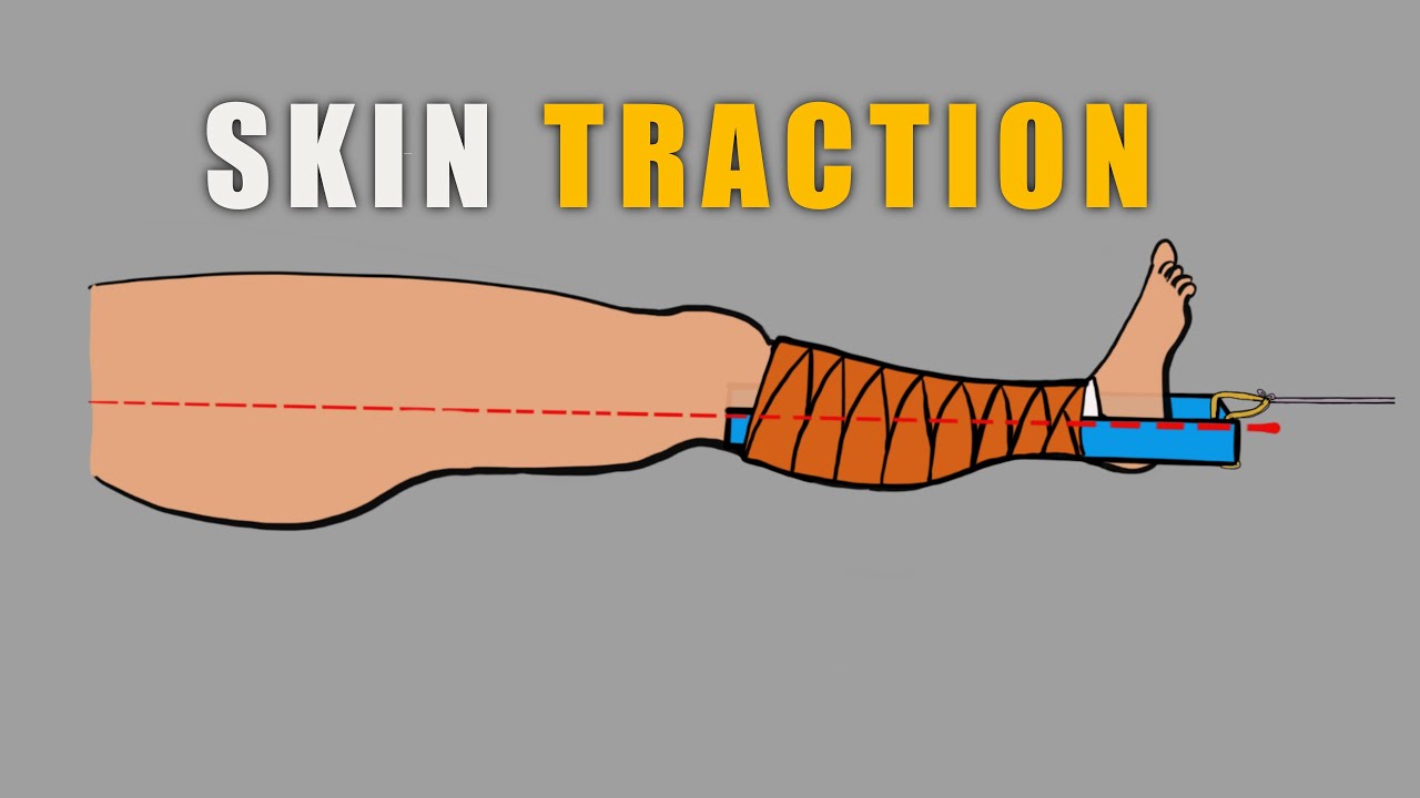 How to apply skin traction | Tractions