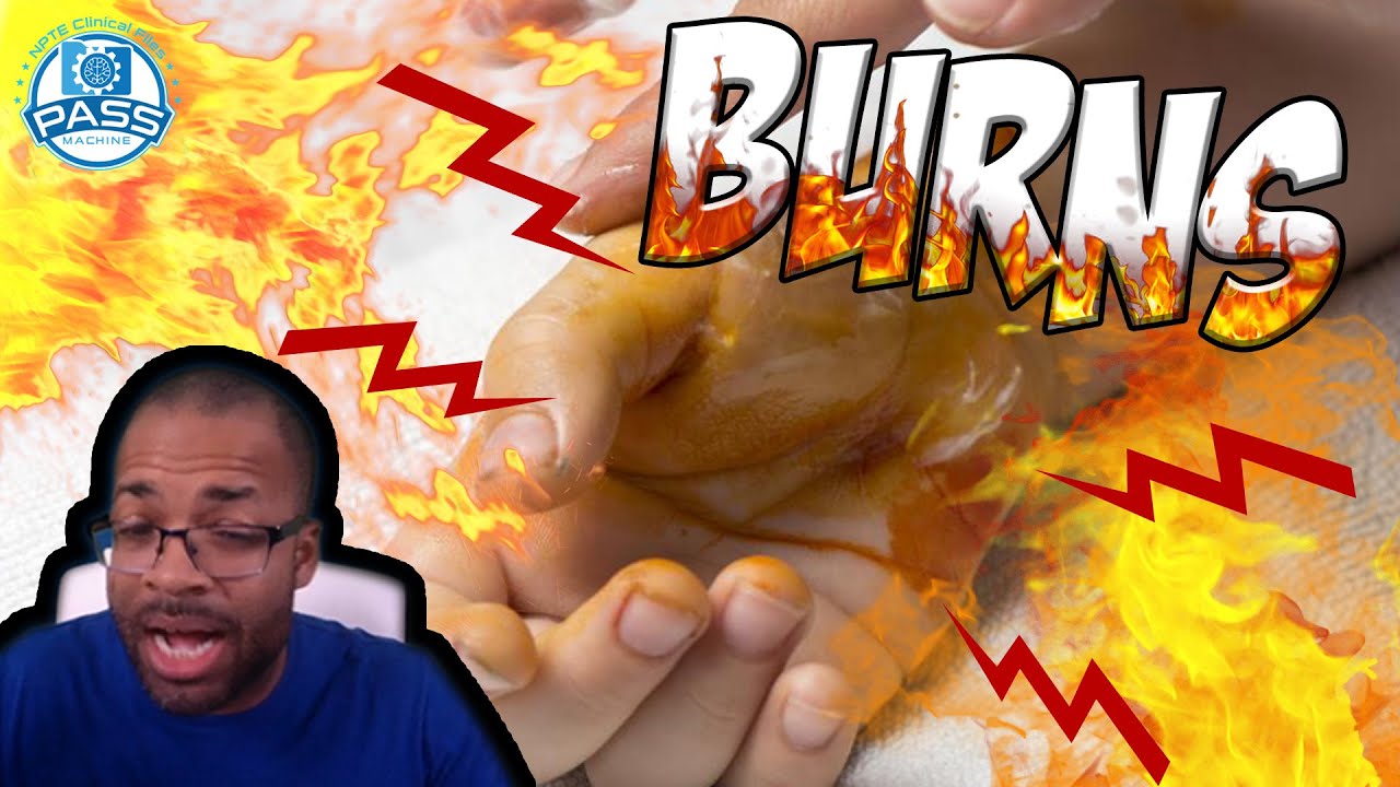 NPTE Practice Questions: Burns on the NPTE