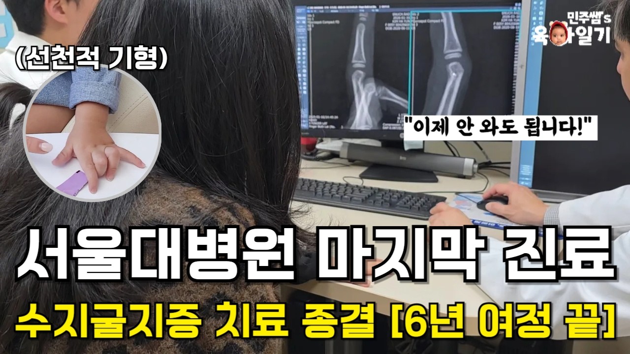 15개월에 시작해 드디어 끝났습니다. 서울대병원 어린이병원 졸업하는 날🫳🏻 선천적 기형 수지굴지증