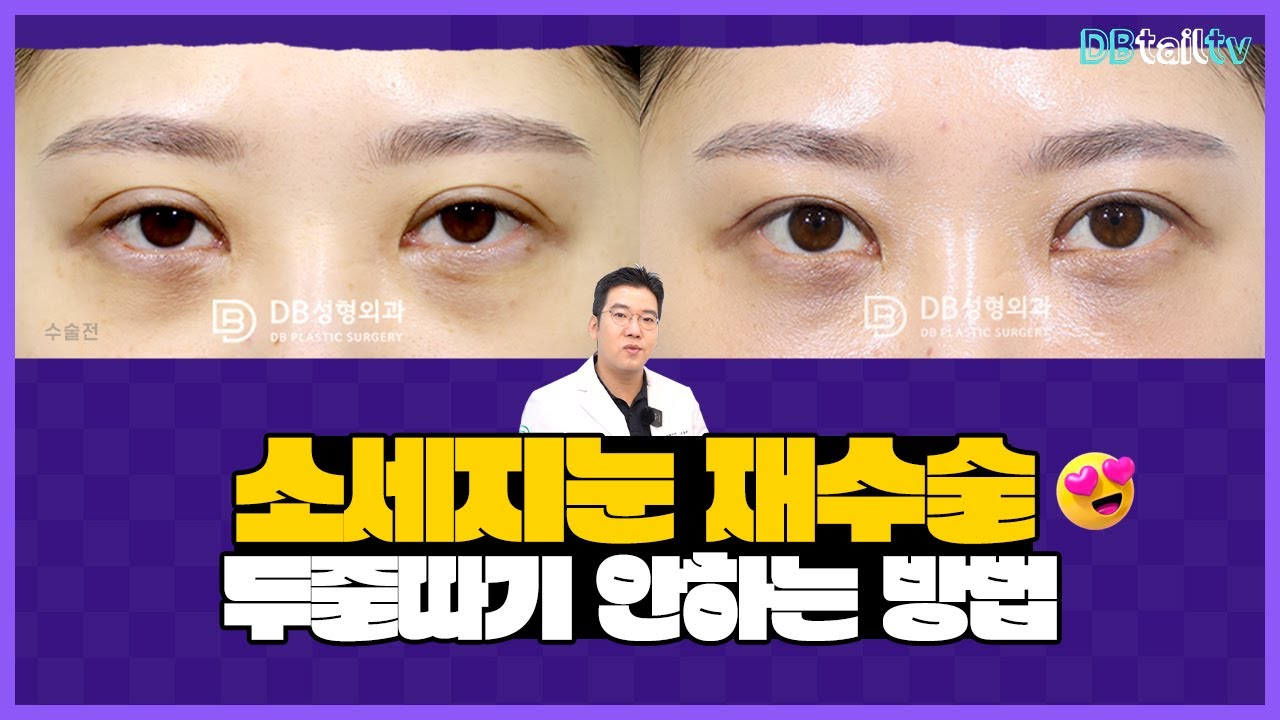 소세지눈재수술 두줄따기 안하는 방법