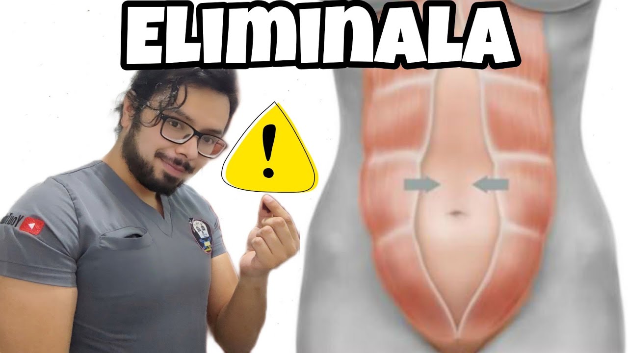 ☠️ Diastasis abdominal: El 70 % de las personas lo padece y no lo sabe ☠️