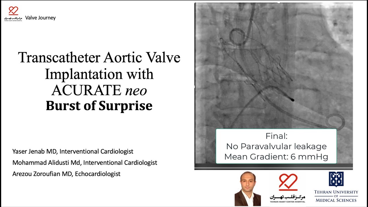 TAVI with the ACURATE neo transcatheter heart valve