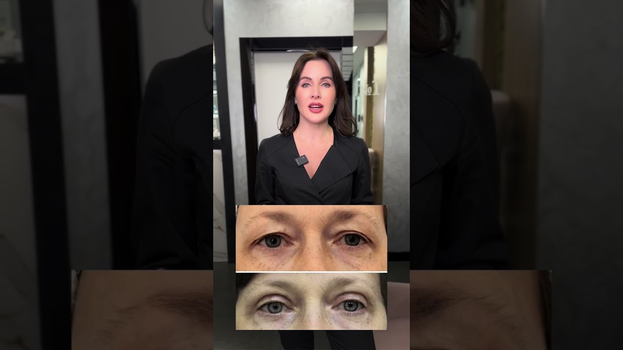 Как убрать нависшее веко при  помощи косметологии #botox #акне #filler#косметология