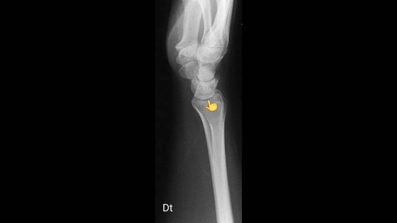 radiographie du poignet de profil.