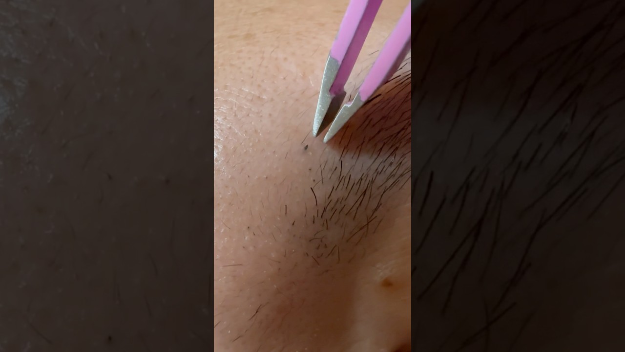Goodbye, Thick Eyebrow Hair #hairremoval #plucking #tweezers