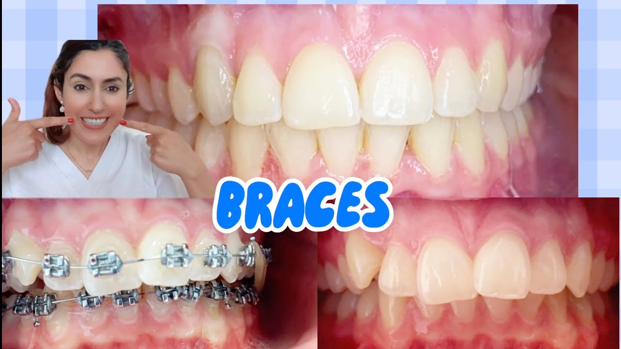 Orthodontist Shows & Explains All Before & After Braces!