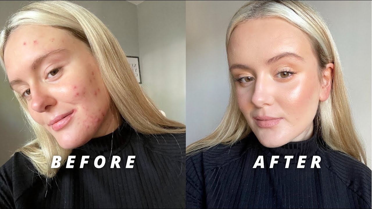NATURAL MAKEUP - PIEL CON ACNE | Nadia Presmanes