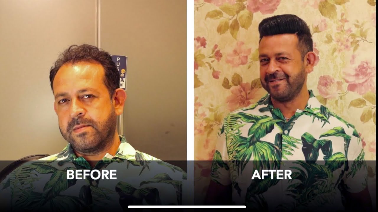 Hair Weaving in Ludhiana, Bathinda, Punjab , 100% Human Hair / Permanent hair replacement