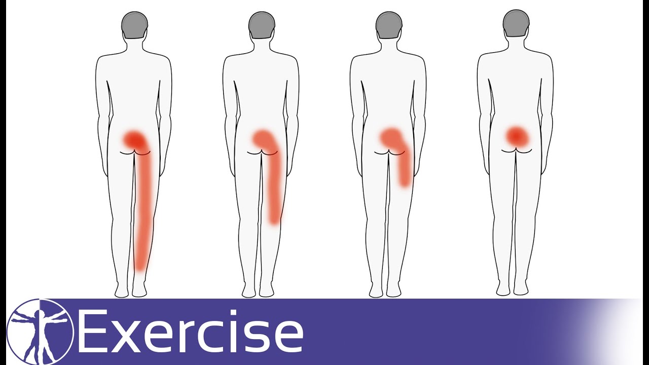 Упражнения для лечения боли в пояснице | предпочтение направлениям