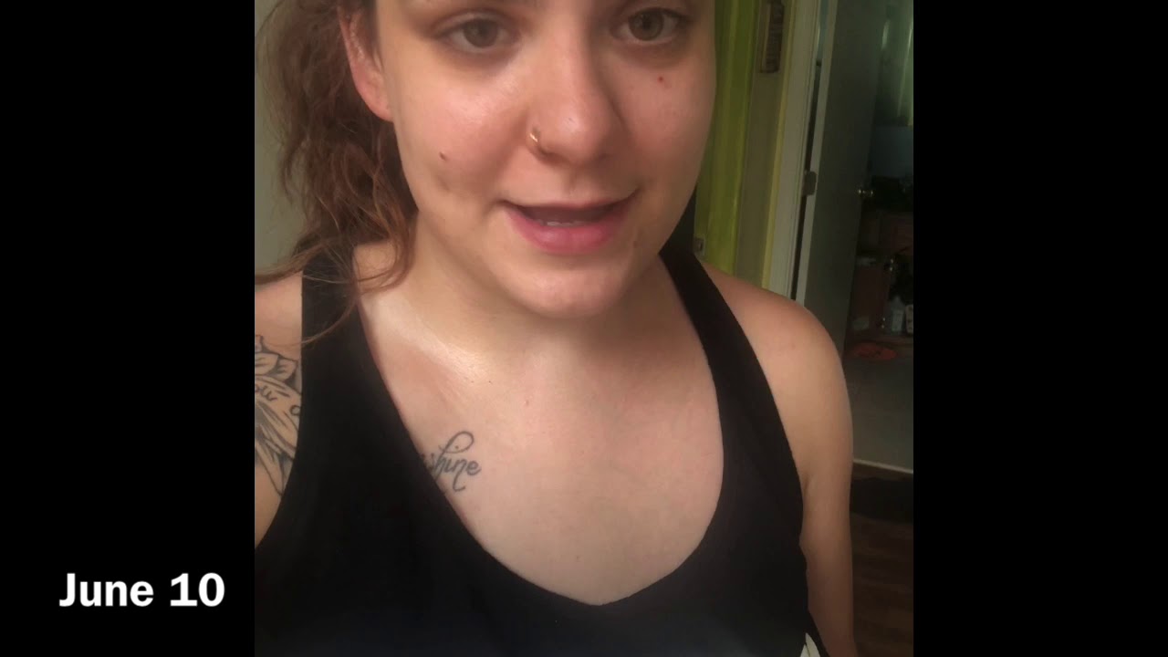 Hydrosalpinx Removal With Salpingectomy. Am I Pregnant?!