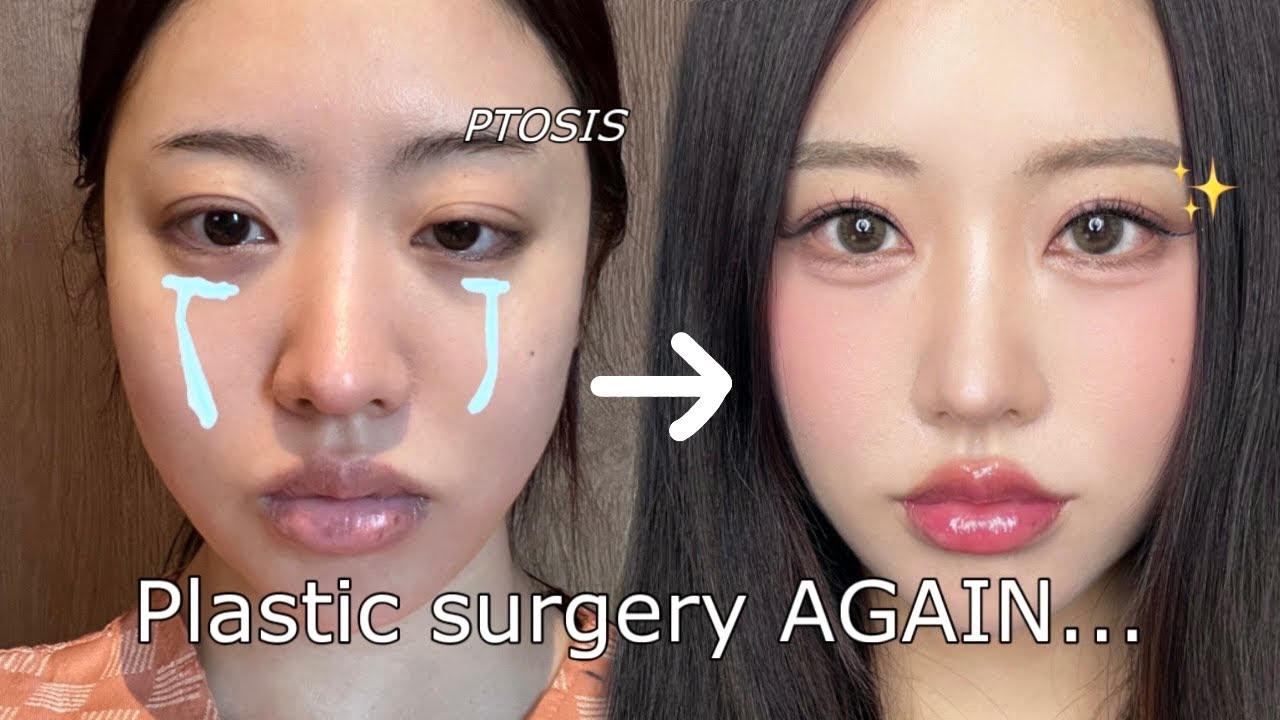 I got my eyes done AGAIN in korea😭 Plastic surgery vlog!