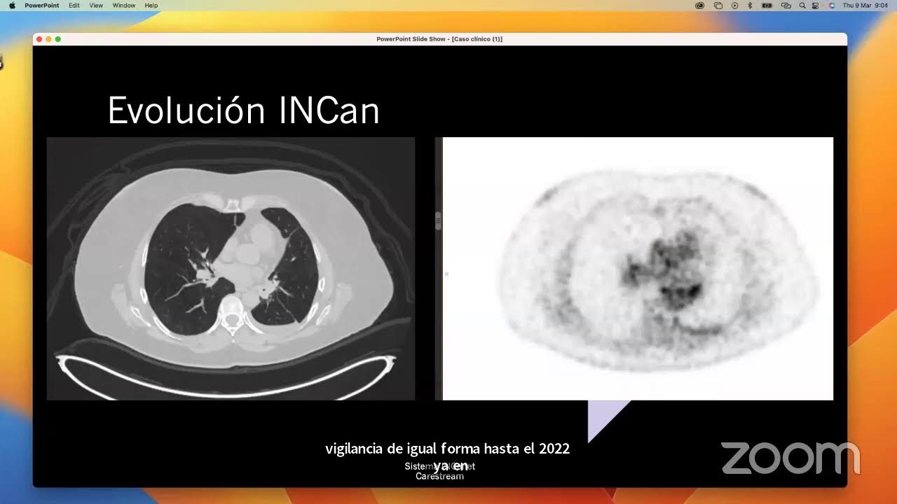 Taller de Contorneo: Cáncer de Pulmón Localmente avanzado
