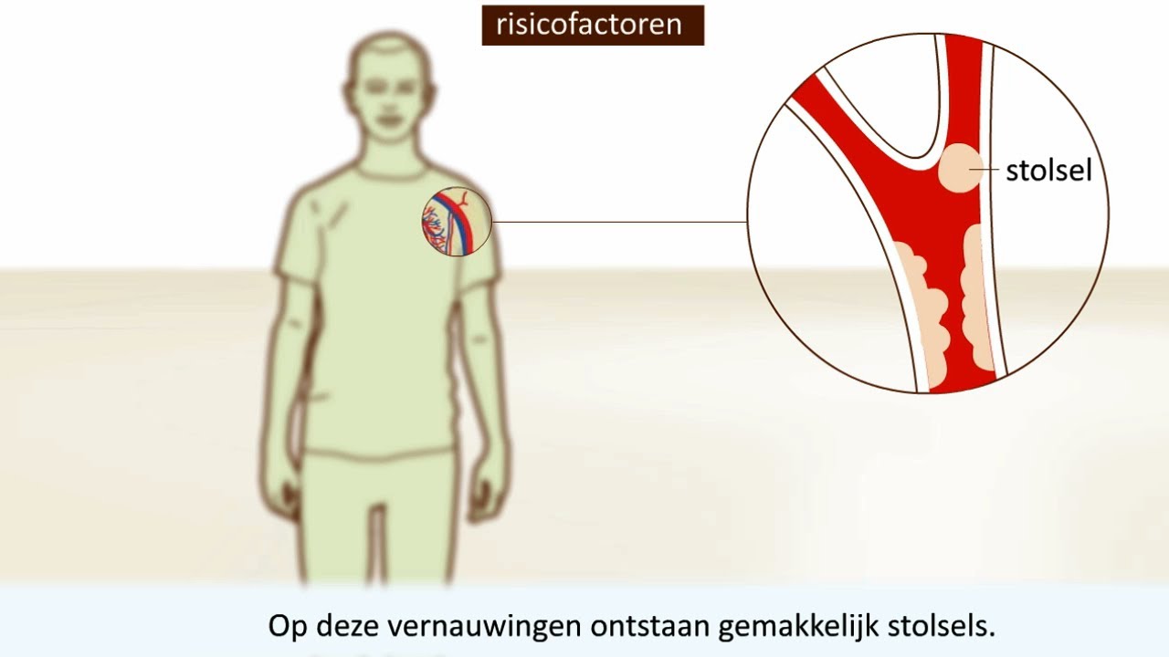 Trombose - Symptomen en behandeling