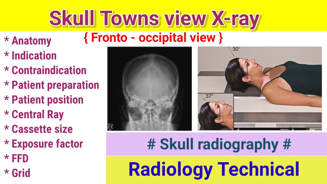 Skull Towns View x-ray Projection # Skull radiography # Patient positioning #radiography #radiology