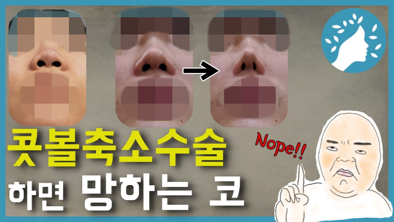 콧볼축소수술하면 망하는 코. 넓은 콧방울은 대부분의 경우 코끝을 높이는 것만으로도 충분히 해결되요. 작은 콧구멍이나 넓은 코끝을 가진 코에서 콧불축소수술은 매우 위험해요.