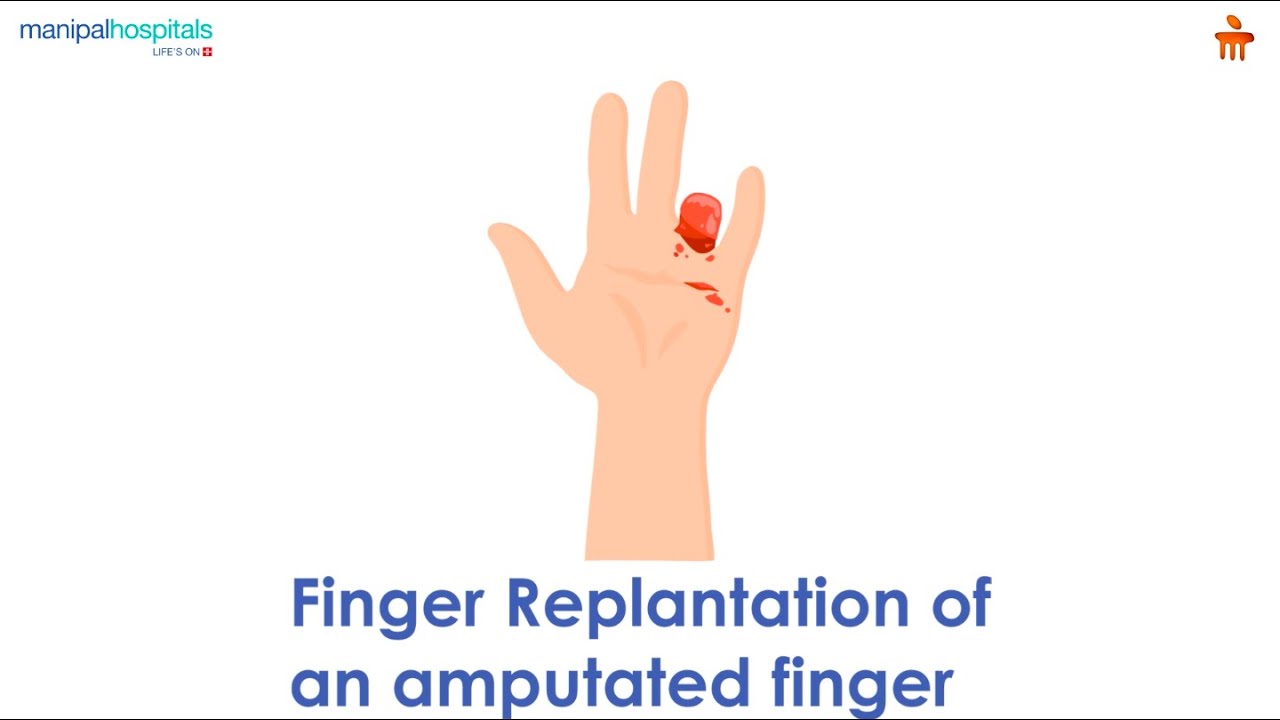 What is Reimplantation in Amputed Fingers? l Manipal Hospitals Bengaluru