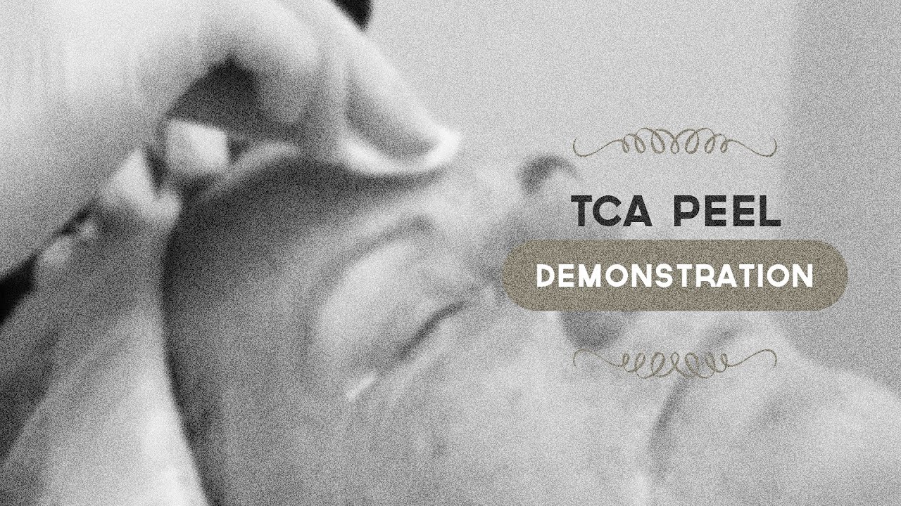 Демонстрация пилинга 35% TCA