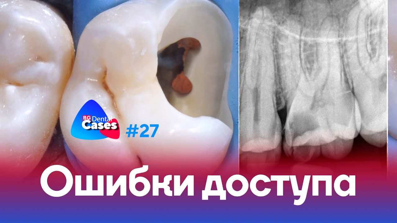 Ошибки эндодонтического доступа | Дентал Кейсы от BG #27
