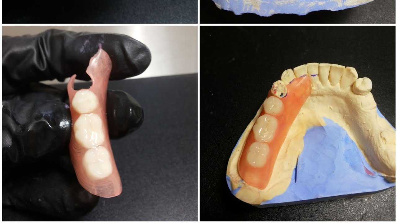 Ελαστική μαλακή οδοντοστοιχία κύπρος οδοντοτεχνικό εργαστήριο / Elastic soft denture _ dental cyprus