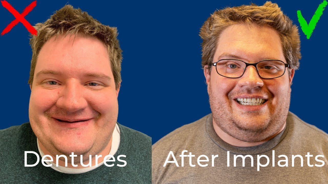 Can Dental Implants Restore Face Shape?