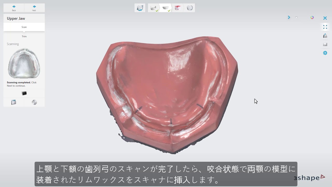 3Shape Dental System - 全部床義歯のスキャン