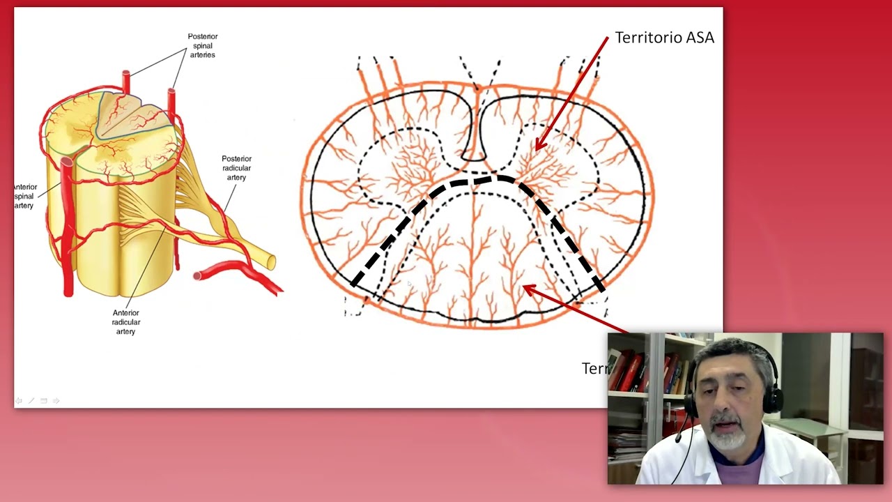 Lesioni ischemiche del midollo spinale. Fisiopatologia, valutazione e riabilitazione #simfercast