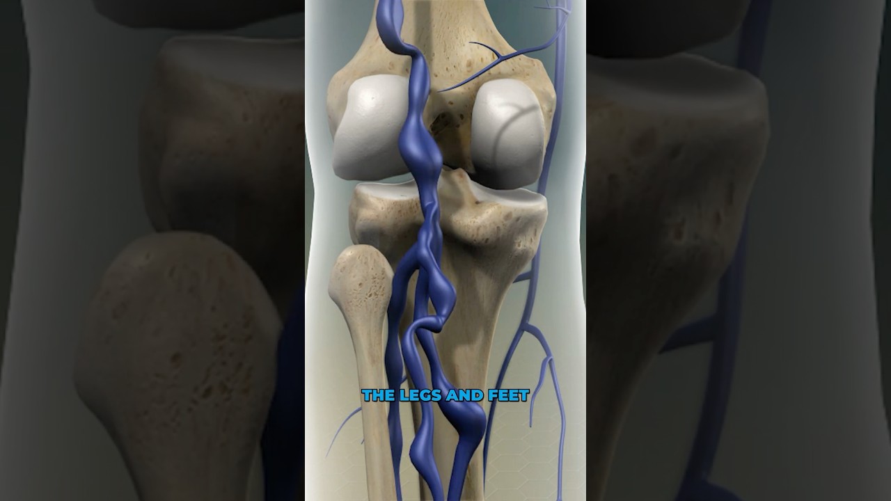 What causes varicose veins? (3D Animation)