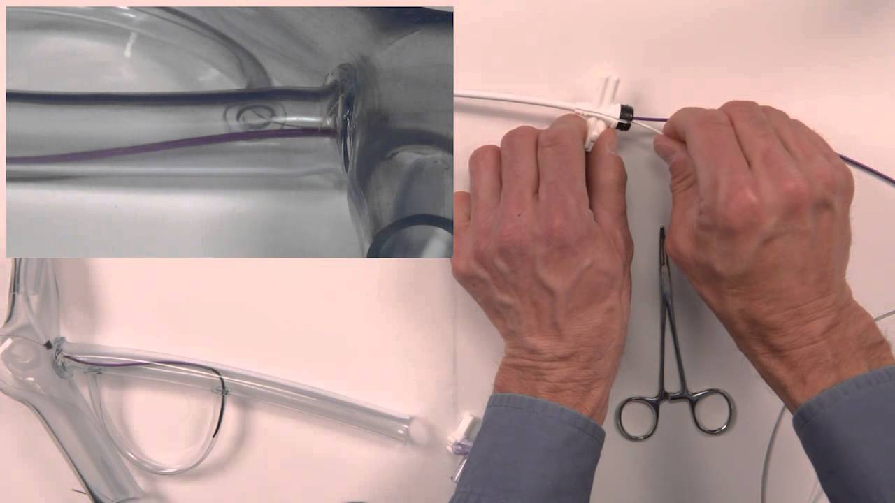 The Worley™ Snare Technique: Overcoming Difficult Vessel Anatomy to Deliver an LV Lead