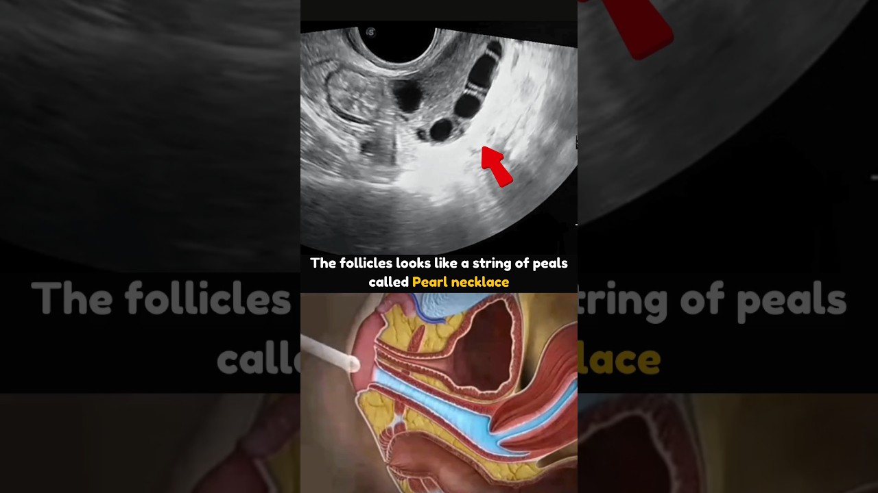 Polycystic Ovaries on Transvaginal Ultrasound 💕 #pcos #pcosinfertility #pcoslifestyle