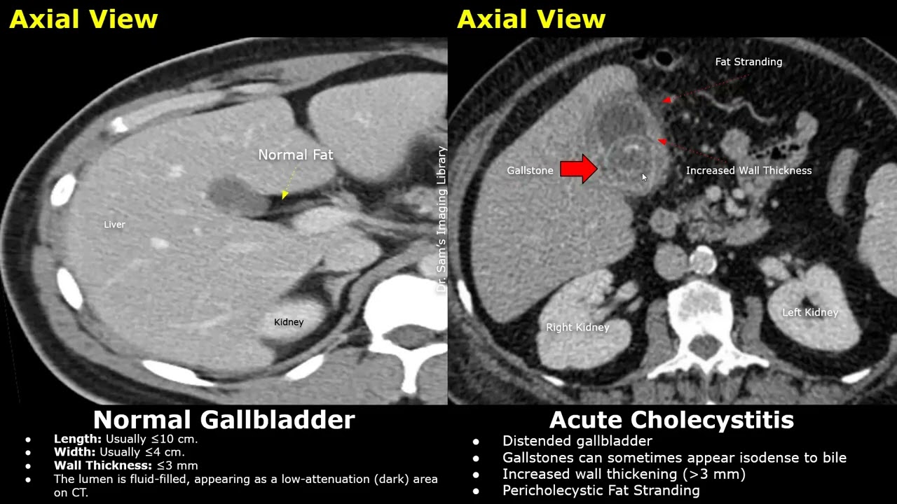 CT Abdomen Gallbladder Normal Vs Acute Cholecystitis | Gallstones, Wall Thickness & Gangrenous Cases