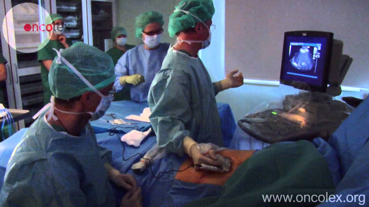 Radiofrequency ablation of liver tumors