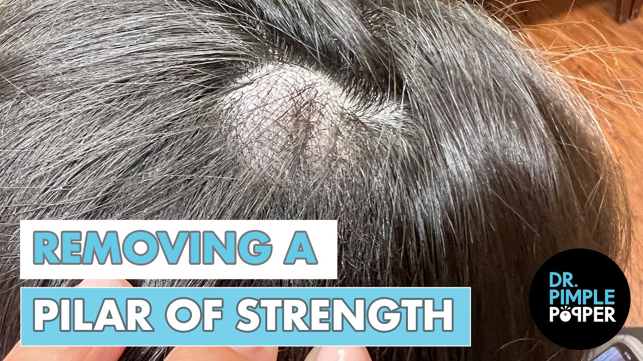 Удаление пилярной кисты | Доктор Пимпл Поппер удаляет пилярную кисту