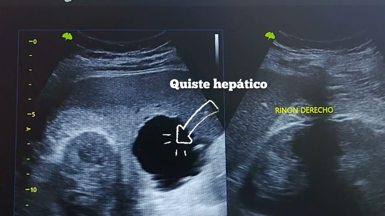 DOLOR ABDOMINAL POR QUISTE HEPATICO E HIDROCOLECISTO EN MASCULINO DE 62 AÑOS