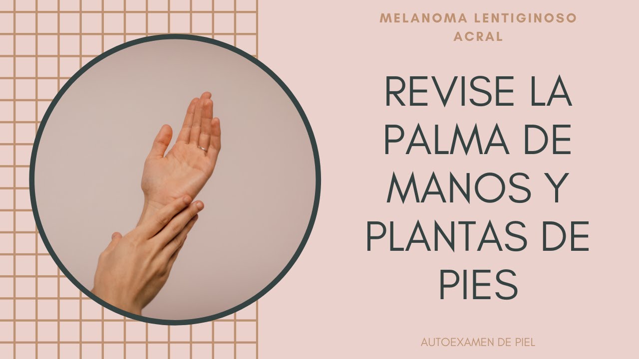 #Melanoma lentiginoso acral un tipo de cáncer de piel