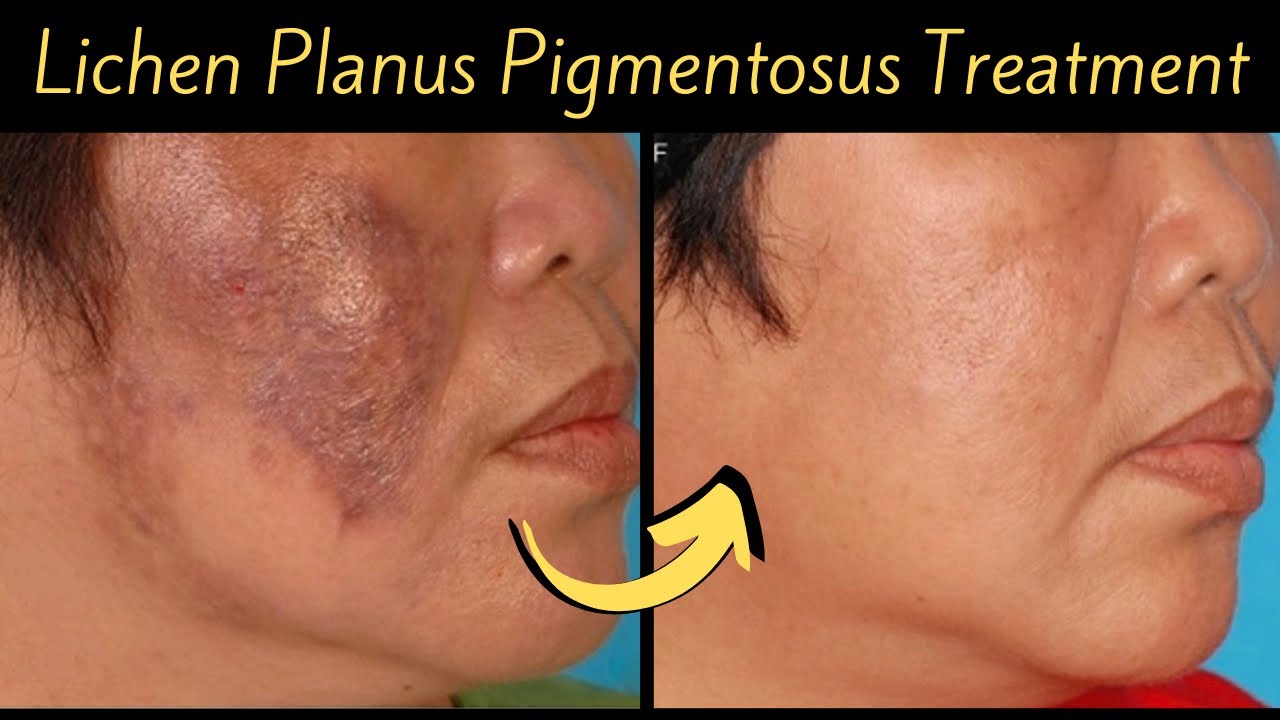How to cure new type of Pigmentation “Lichen Plans Pigmentosus” - झाँइयों की नयी क़िस्म