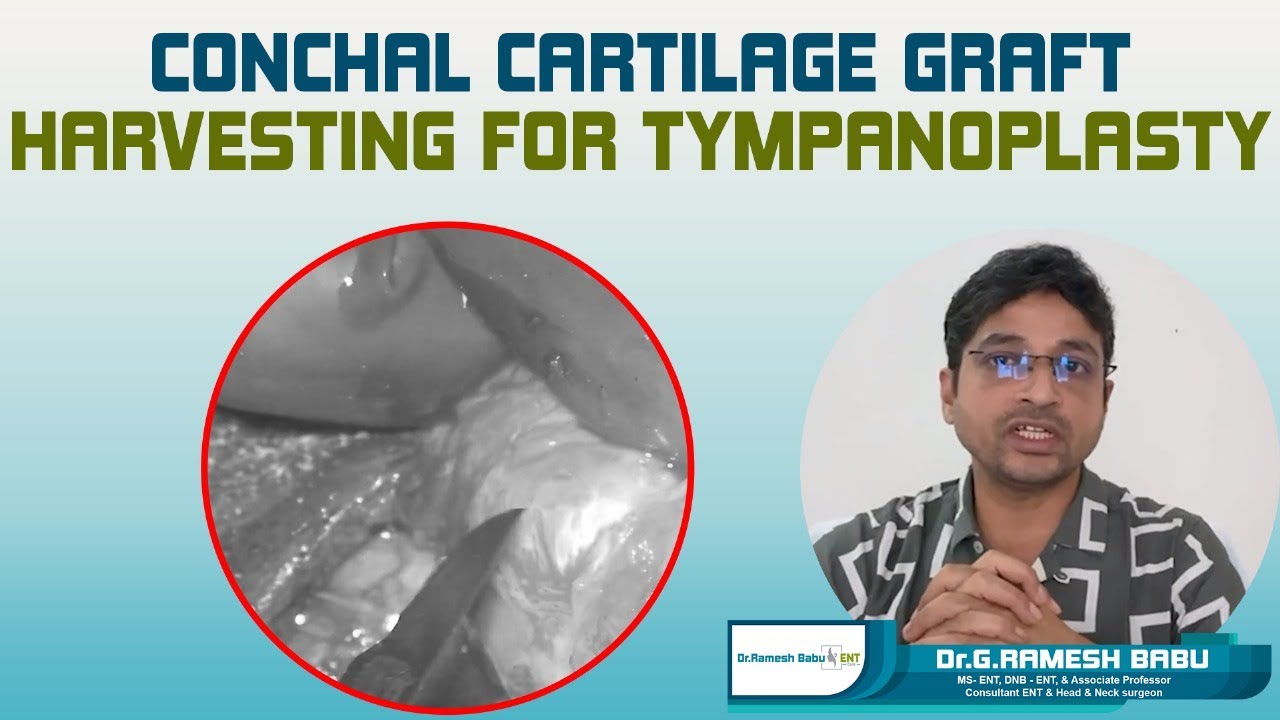 CONCHAL CARTILAGE GRAFT HARVESTING FOR TYMPANOPLASTY || Dr Ramesh Babu ENT