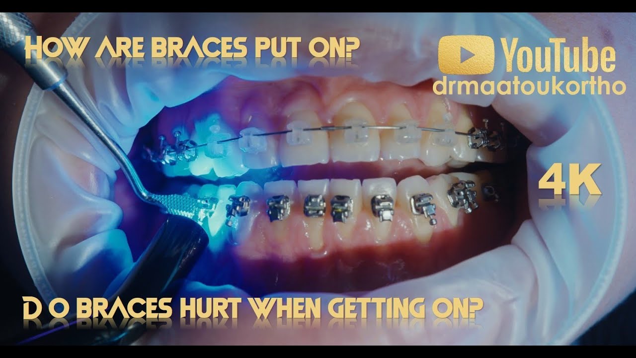 Do braces hurt when getting on? How Are Braces Put On? هل يؤلم تركيب تقويم الأسنان؟ و ماهي المراحل ؟