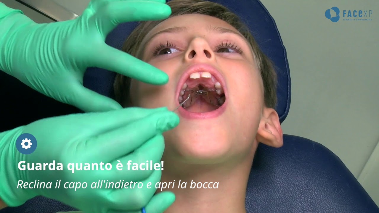 Come attivare l'espansore del palato - STUDIO DENTISTICO DE PIERI - CENTRO FACE XP
