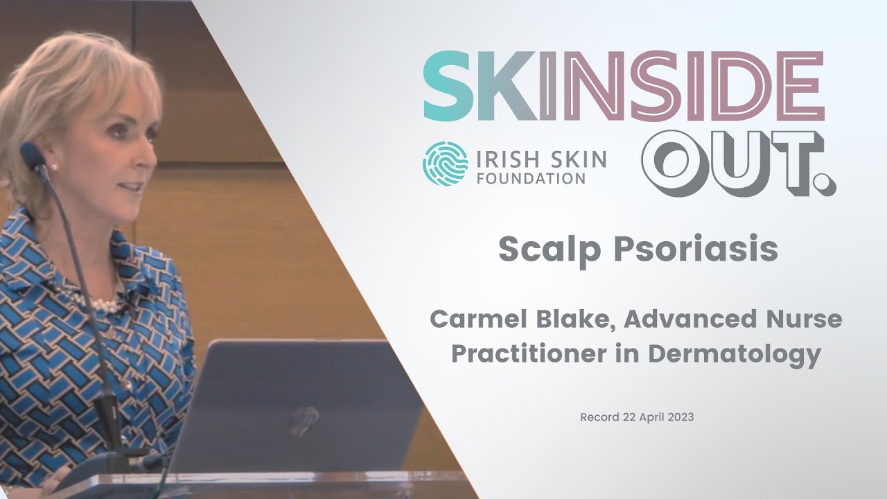 Scalp Psoriasis