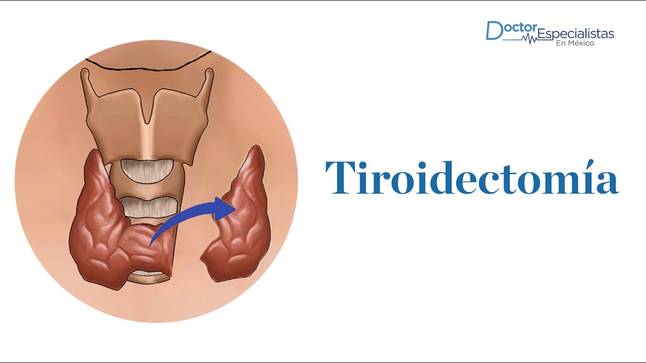 Tiroidectomia - Doctor Especialistas Mexico