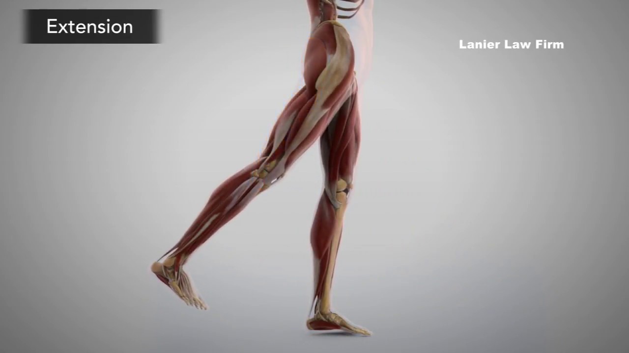 Animation:  How hip replacements can fail