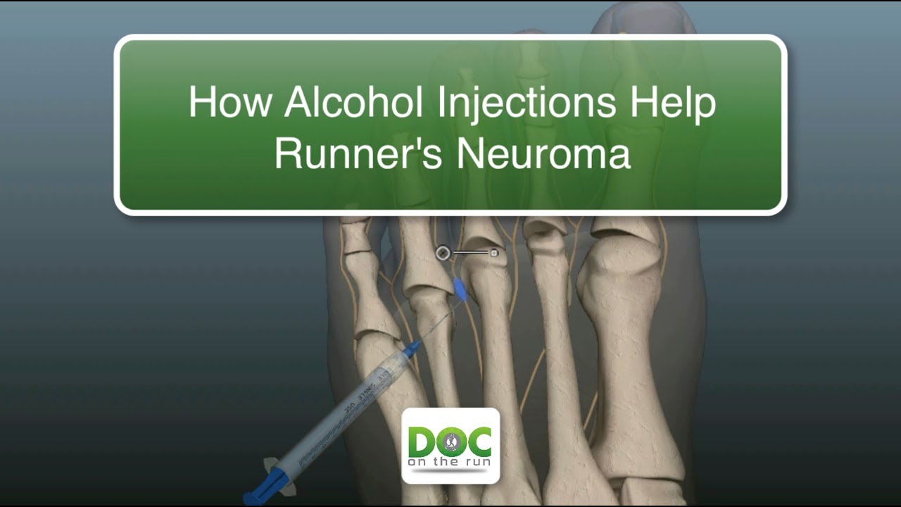 How Alcohol Injections Help Runners with Neuroma Pain