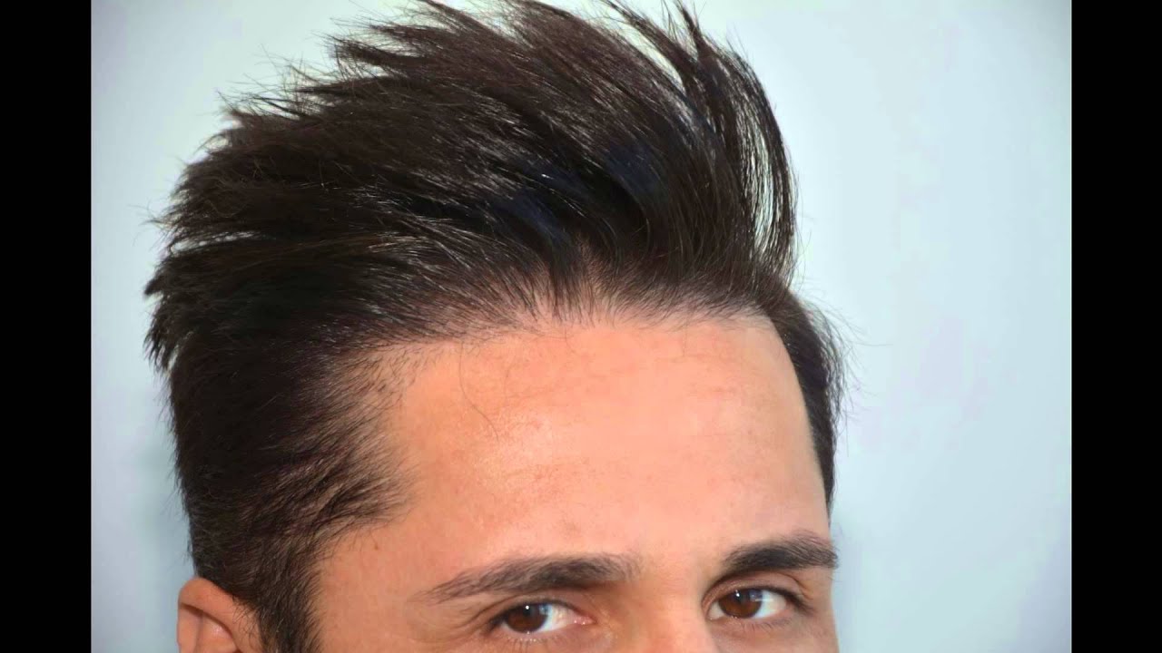 FUE Hair Transplant 1700 Grafts By. Dr.HAKAN DOGANAY