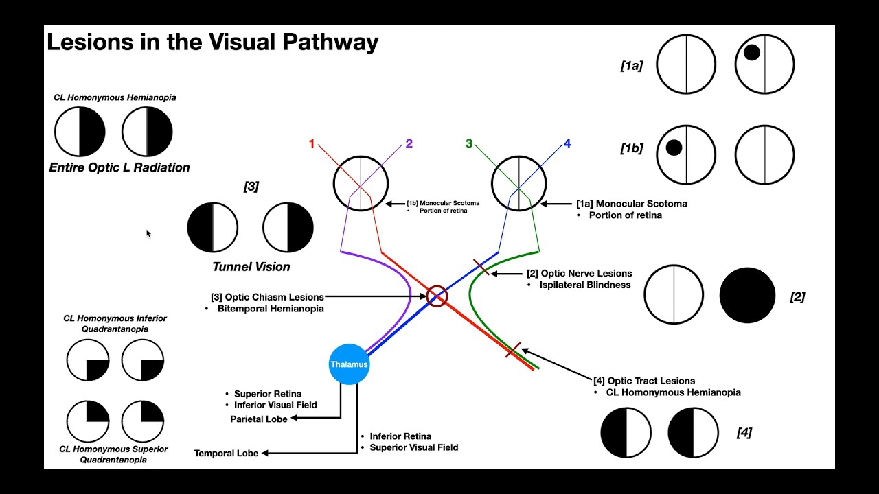 Lesions to the Visual Pathway EXPLAINED